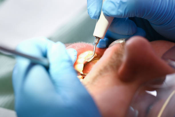 Best Emergency Treatment for Dental Infections or Abscesses in Greenville, NY